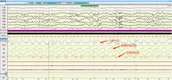 “倒头就睡”一定是睡眠很好？如伴有这些症状需警惕