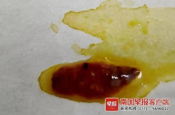 头皮发麻！广西女子腹部疼痛，体内陆续有活虫爬出！只因这个习惯……