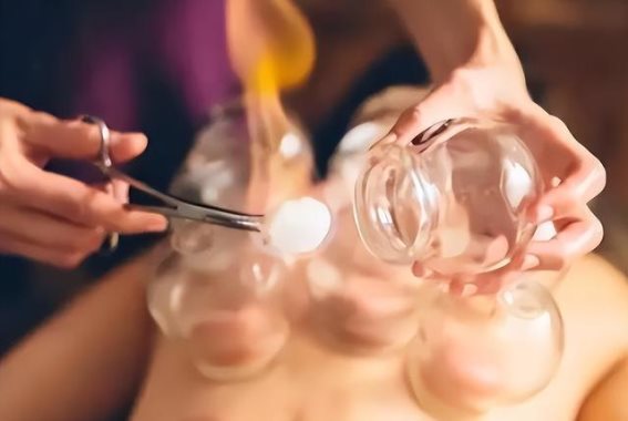 熊导航报道：拔火罐：深入解析传统疗法的原理与效应