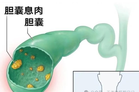 胆囊息肉的治疗误区与中药破瘀新思路