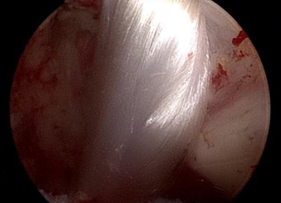 昆明市延安医院成功实施首例人工韧带植入手术，开启关节损伤治疗新纪元