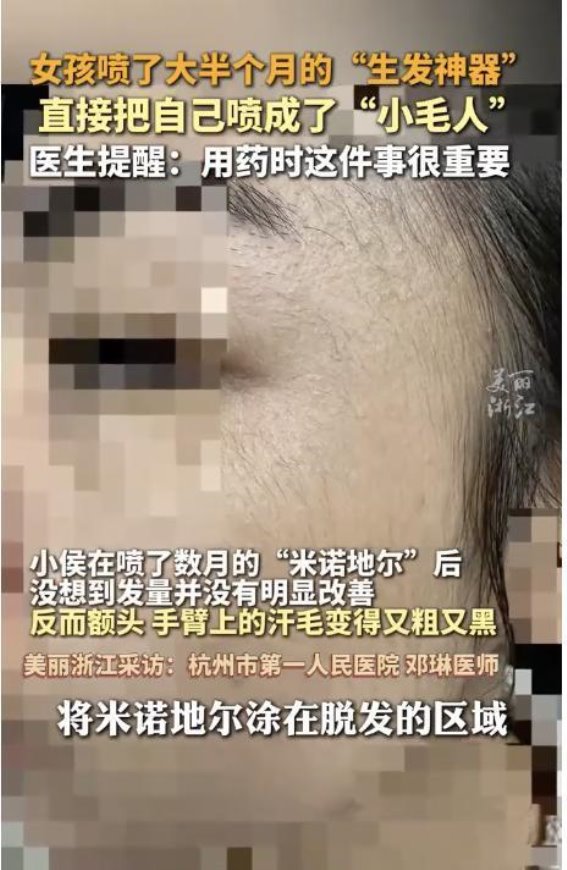 米诺地尔使用不当引发的副作用：如何正确使用避免误区