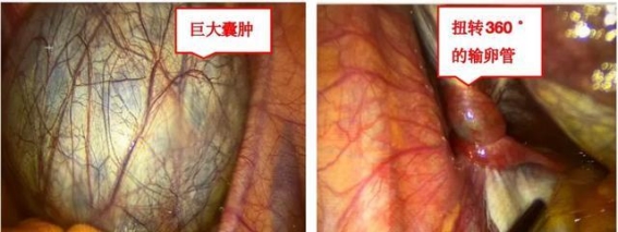 16岁女孩腹痛急症，如何成功抢救输卵管系膜囊肿蒂扭转