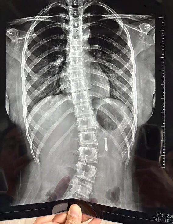 老年人一般多少岁开始驼背？出现驼背后，需注意啥？