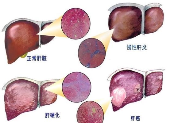 癌症早期的信号，体检报告里可能早已告诉你