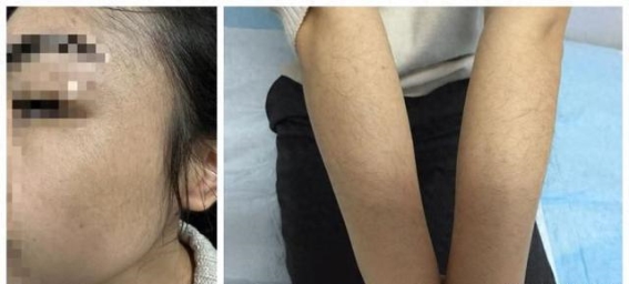 正确使用米诺地尔生发药物，避免副作用带来的困扰