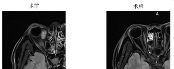 鼻子里做手术？新技术助你重见光明！