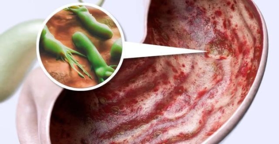 幽门螺杆菌只是其一 胃炎反复的三个核心原因不可忽视