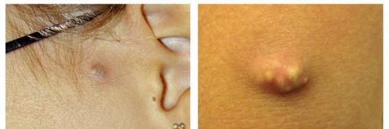 身体突然冒出“小包包”？别急着抠，这些健康信号不能忽视！