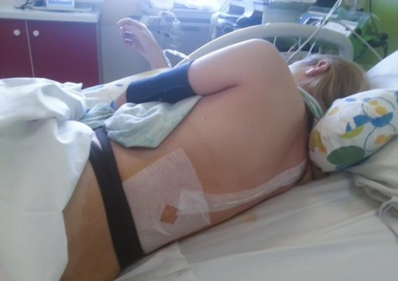 术后恶心呕吐与止疼泵：如何在痛苦与副作用之间找到平衡？