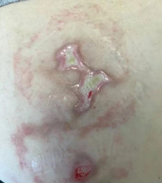 寒冬保暖不当小心低温烫伤，特别是这几类人群要警惕