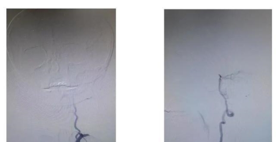 全脑血管造影术（DSA）：精准诊断为脑血管疾病治疗提供坚实基础