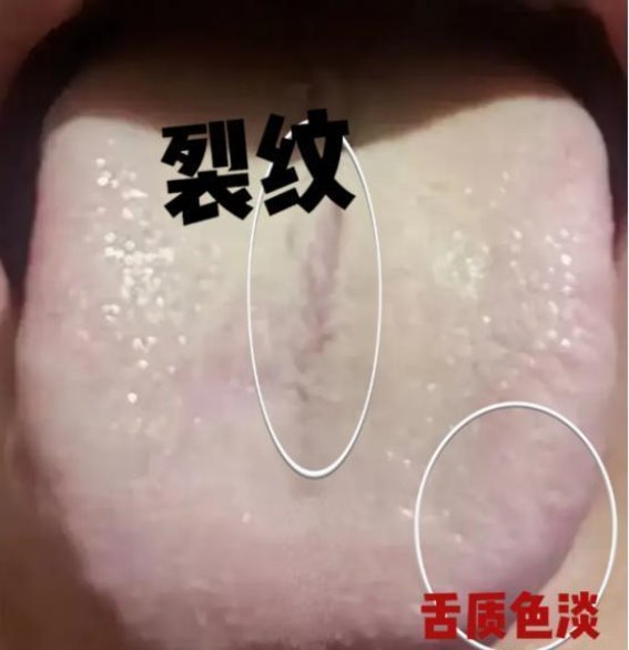 寒湿化热的治疗方法