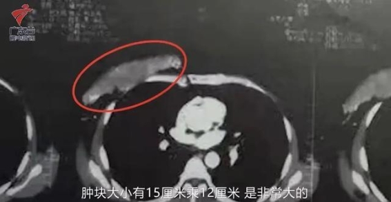 男人常忽视的乳腺癌，死亡率更高，确诊时已是晚期