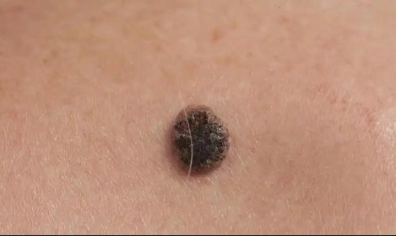 患上这4种癌症，早期治疗让你重回健康生活