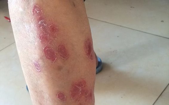 皮肤癌的早期信号：如何识别身体的异常变化