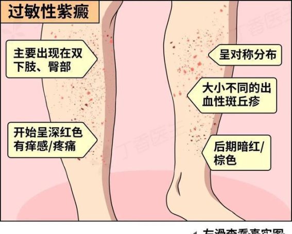 身上突然冒出小红点，这可能是紫癜吗？