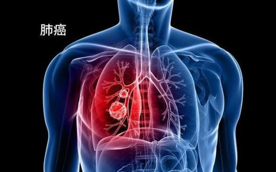 头部异常或是肺癌的预警信号：你不可忽视的健康警示