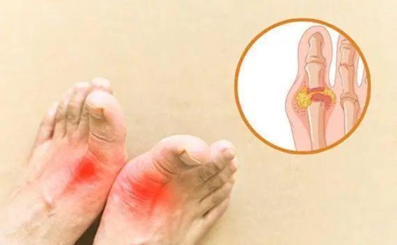 这些痛风用药误区可能让你病情加重！