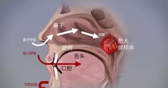 中医如何非手术治疗腺样体肥大