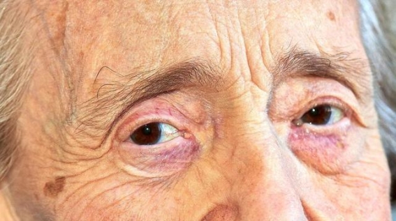眼睛能透露寿命的秘密？医生告诉你长寿的眼部特征