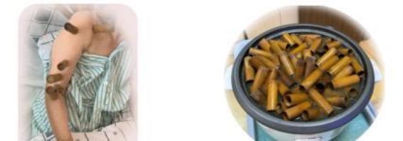 冬季中风后肩手综合征的中医康复治疗之道