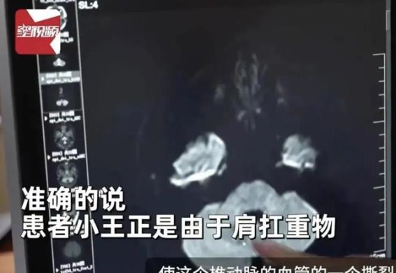 26岁小伙背包成“元凶”，突发脑梗的背后