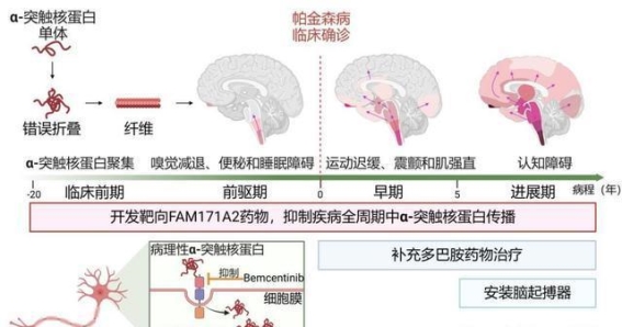 科学家发现帕金森病新治疗靶点 为早期干预提供新希望